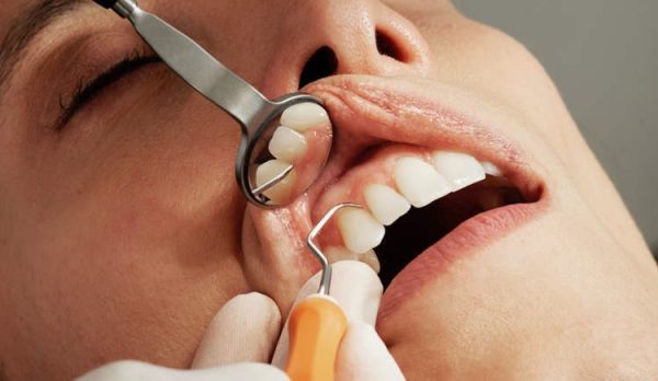 Tự nhổ răng trong hơn 10 năm vì không hẹn nổi nha sĩ
